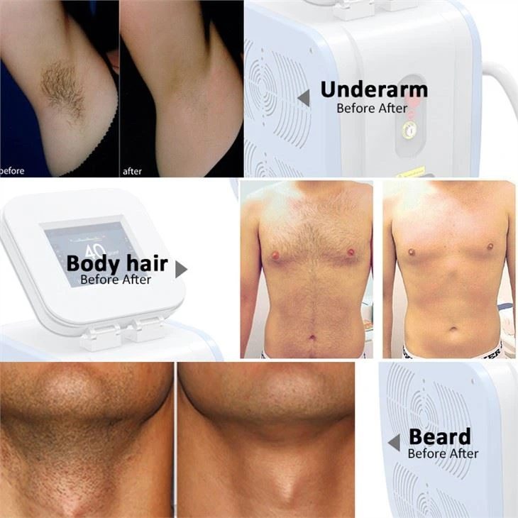 Keslaser 808nm Diode Laser Super Hair Removal Machine